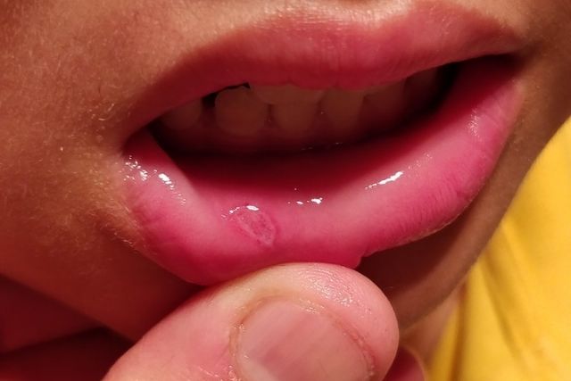 What is Mouth Ulcer and how to get rid of it