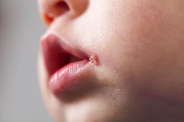 What is Mouth Ulcer Treatment